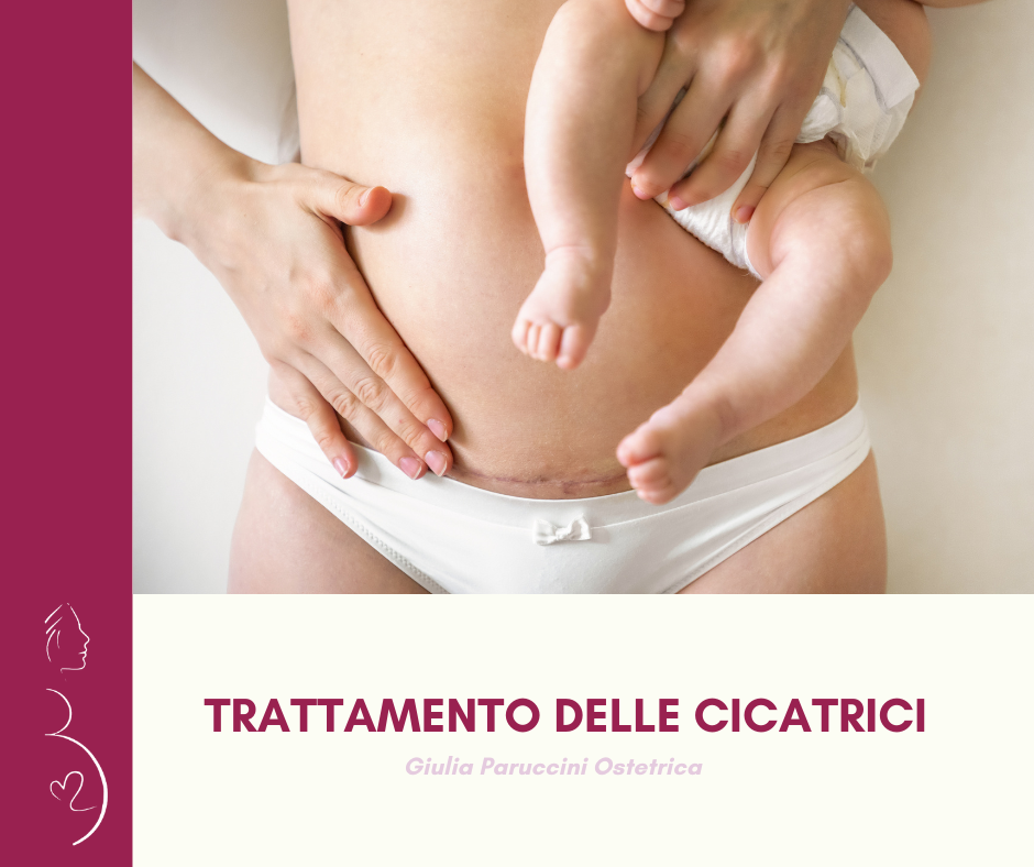 Trattamento delle cicatrici Giulia Paruccini Ostetrica